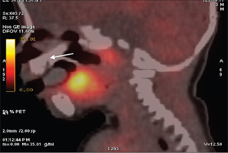 25-year-old female with gravida 2 para 1 evaluated for polyhydraminos. Fetus was later diagnosed with oropharyngeal teratoma. PET CT image of the child, 6-months posttreatment shows metabolic activity in the tongue and adenoids are physiological. Soft palate (arrow), where the original tumor was resected is normal indicating no recurrence of tumor.