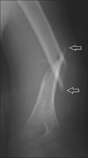 Five-year old boy with a crush injury extending from his shoulder to the distal part of his left arm. X-ray shows spiral fracture of the distal diaphysis of the left humerus (arrows).