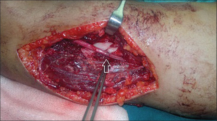 Five-year old boy with a crush injury extending from his shoulder to the distal part of his left arm. Photograph shows radial nerve (arrow) repaired by microsurgery.
