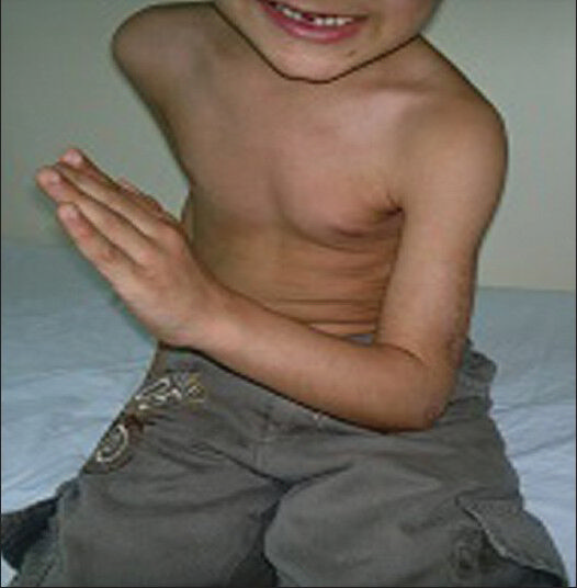 Five-year old boy with a crush injury extending from his shoulder to the distal part of his left arm. Photograph of the arm and wrist six-months after the opeartion shows the affected wrist and digits of the patient had regained full extension.
