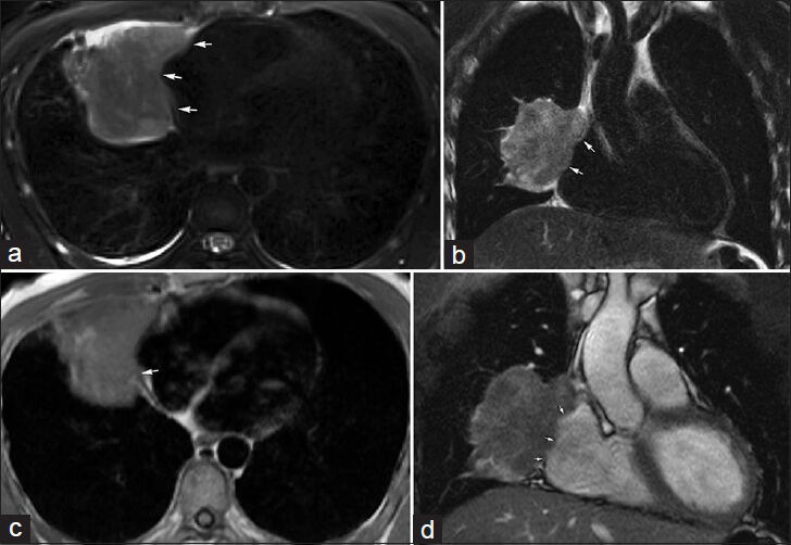 32-year-old male with biopsy-proven sarcomatoid carcinoma involving the right middle lobe. MRI was performed to evaluate disease extent. (a) Axial and (b) coronal T2-weighted images using a PROPELLER/BLADE technique demonstrate the lobulated right middle lobe mass invading the mediastinal fat medially (arrows). (c) Gated double inversion-recovery FSE “black-blood” image shows the loss of the hypotense pericardial line (arrow), and (d) real-time free-breathing bSSFP image shows lack of apparent separation (arrows) highly suspicious for pericardial invasion, a finding confirmed at surgery.