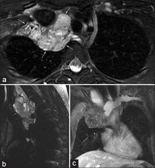 25-year-old female with chromosomal abnormality, mediastinal mass, and severe combined pectus excavatum and carinatum deformity. (a) Axial and (b) sagittal T2-weighted images demonstrate a multilobulated, multiseptated cystic mass (arrows) with multiple fluid-fluid levels in the right side of the superior mediastinum extending into the right side of the neck and to the junction of the superior vena cava and the right atrium. (c) Coronal postcontrast T1-weighted image demonstrates thin septal enhancement (arrows). Findings are consistent with a large lymphatic malformation for which the patient had previously undergone surgery.