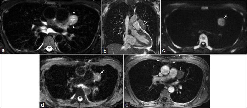 A 45-year-old female with chronic upper respiratory symptoms and dry cough. (a) Axial T2-weighted image and (b) coronal bSSFP image demonstrate an elongated rounded mass (arrows) with internal cystic areas along the course of the left phrenic nerve. (c) Diffusion-weighted image using b=800 s/mm2 and correlating (d) apparent diffusion coefficient (ADC) map show no appreciable restricted diffusion (arrow). (e) Contrast-enhanced axial image demonstrates minimal enhancement of this mass (arrow). Differential considerations include thymoma and left phrenic nerve sheath tumor. The mass was resected with pathology indicating a thymoma with extensive cystic change.