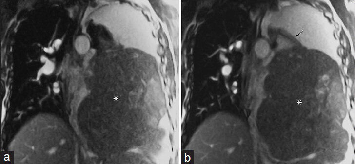 53-year-old male with a large left hemithorax mass. (a and b) Coronal noncontrast-enhanced real-time free-breathing bSSFP images demonstrate a large extra-pulmonary mass (*) that arises from the left inferior pulmonary ligament (arrow). Differential considerations include sarcoma or fibrous tumor of the pleura. This was surgically excised with pathology indicating solitary fibrous tumor with focal tumoral necrosis.