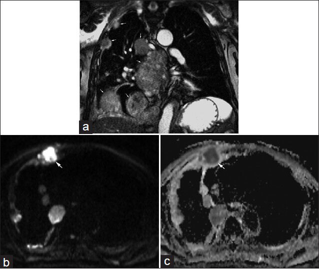 85-year-old male with malignant mesothelioma having focal right-sided anterior pain. (a) Coronal real-time free-breathing bSSFP image illustrates multiple pleural masses (arrows) consistent with known malignant mesothelioma. (b) Diffusion-weighted image using b=800 s/mm2 and corresponding (c) apparent diffusion coefficient (ADC) map demonstrate restricted diffusion in one of the pleural masses (arrow). The location of this mass corresponded with the region of focal pain.