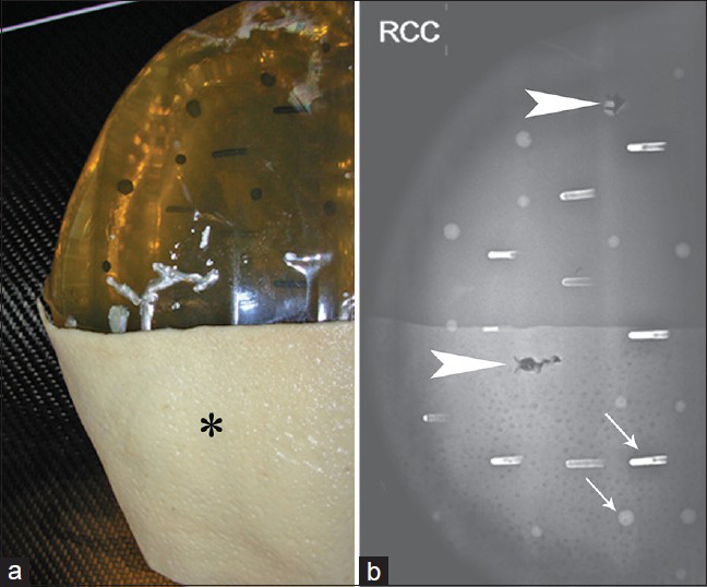 Mammogram of hydrated ex vivo AlloDerm®. (a) A single sheet of AlloDerm® (asterisk) was placed on the medial aspect of a breast phantom, and (b) a right craniocaudal view obtained shows the AlloDerm® is isodense to “glandular” tissue; several air/AlloDerm® interfaces are visible. There are simulated calcifications (arrows) and two biopsy tracts (arrowheads) in the phantom.