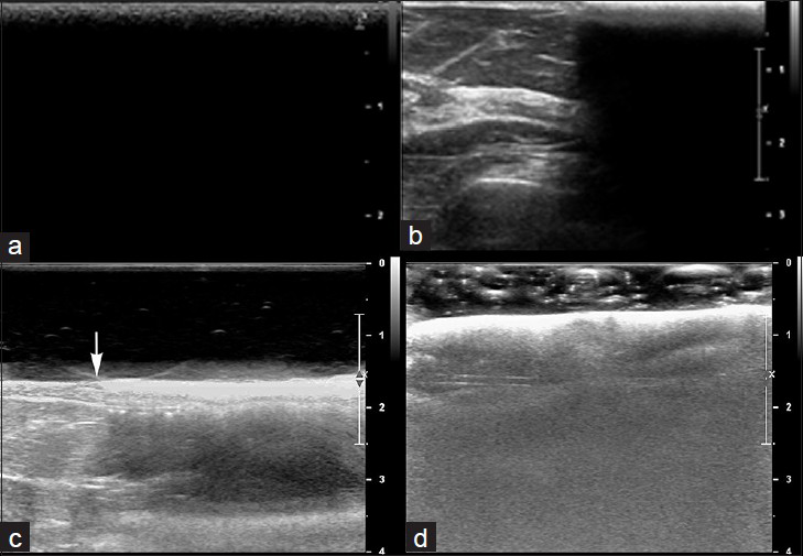 Ultrasound of hydrated ex vivo AlloDerm®. (a) Transverse view shows a single sheet of AlloDerm® overlying the skin in the field of view entirely. (b) Transverse view of partially visualized AlloDerm® adjacent to normal breast parenchyma, shows the AlloDerm® is hyperechoic to normal breast parenchyma and demonstrated posterior acoustic shadowing. (c) Additional transverse view of normal breast with and without AlloDerm® on top of the breast (junction denoted with an arrow) was performed using a standoff gel pad reveals the hyperechoic surface of the AlloDerm®. Artifacts presumably caused by the microairbubbles within the acellular AlloDerm® can be seen deep to the AlloDerm®. (d) AlloDerm® immersed in sonographic gel also shows these artifacts.