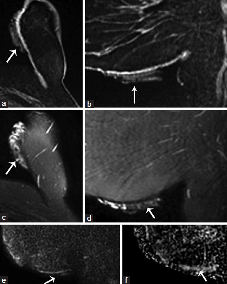 MRI of hydrated ex vivo AlloDerm®. Noncontrast MRI imaging with technique meeting ACR-accreditation standards was performed on a GE Signa HD 1.5T Magnet (Waukesha, WI). A folded sheet of AlloDerm® was taped to the inferomedial aspect of the left breast (arrows). Fat saturated T1-weighted 3D spoiled gradient-recalled echo (SPGR) (a) axial and (b) sagittal reformatted images show AlloDerm® exhibiting hypointense-to-isointense T1 signal compared with glandular breast tissue. Fat-suppressed T2-weighted (c) axial and (d) sagittal images of AlloDerm® demonstrate hyperintense T2 signal with heterogeneity which is likely related to the folded configuration of the AlloDerm®; and (e) sagittal diffusion-weighted imaging (DWI) and (f) apparent diffusion coefficient (ADC) images of AlloDerm® show no restricted diffusion.