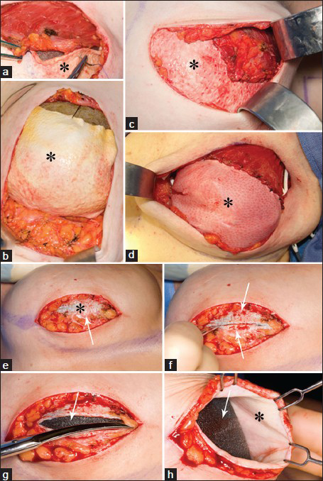 Intraoperative photos of AlloDerm® (asterisk) placement and suturing initially (a-d) and (e-h) 4 -months later. (a, b) With the tissue expander in place, the AlloDerm® is shown sewn to the pectoralis major muscle above and the inframammary fold below. (c and d) The AlloDerm® is checked for contour and a “hand in glove” fit to the overlying skin envelope. (e-h) Four months later, at a second stage, the patient undergoes implant exchange with removal of the tissue expander. Just deep to the subcutaneous fat the incorporated AlloDerm® is seen (e, asterisk). Bleeding after incising the AlloDerm® demonstrates host incorporation and vascularization (e and f, arrow). The tissue expander (g and h, arrow) is exposed, and the undersurface of the incorporated AlloDerm® can be visualized (h, asterisk).