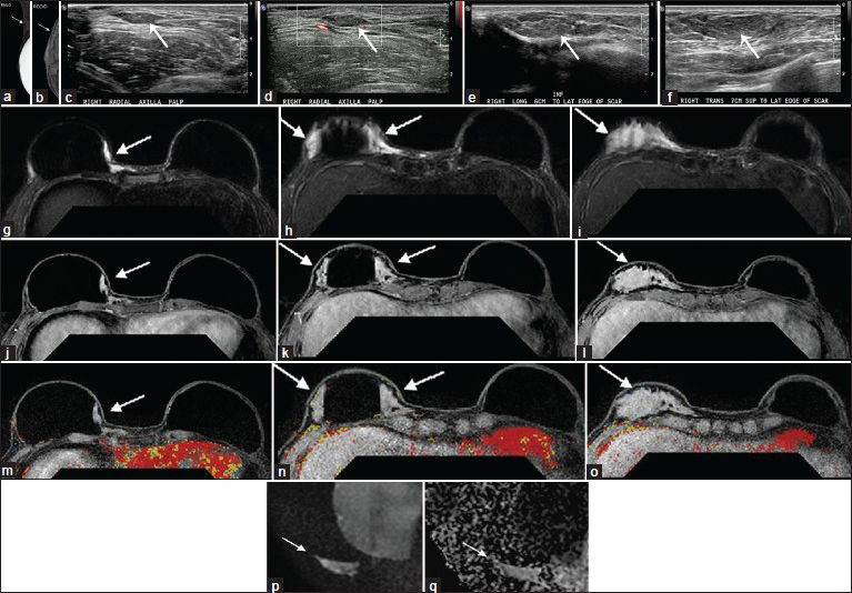 Case 1: 36-year-old female with bilateral skin sparing mastectomies and implants. Mammogram: (a) Right mediolateral oblique (MLO) and (b) right craniocaudal (CC) implant displaced views demonstrate multiple variable-sized circumscribed masses (arrows) that are isodense to normal glandular tissue and most prominent along the lateral aspect of the implant and the axillary tail. Targeted Ultrasound: (c), without and (d) with color flow in the right axilla at the palpable area of concern, demonstrate multiple isoechoic, vague parallel hypoechoic to isoechoic masses with smooth margins (c and d, arrows). There is a small amount of vascular flow within the axillary mass. (e and f) Transverse and longitudinal sonographic views of the right breast demonstrate some of the masses resembling fatty lobules extending approximately 6 cm inferior to the lateral edge of the mastectomy scar to 7 cm superior to the lateral edge of the scar (e and f, arrow). Similar findings continue to extend toward the axilla adjacent to the implant (images not shown). MRI: Fat-suppressed T2-weighted images (g-i) at three different axial slice locations (superior to inferior) show there is an elongated slightly lobulated area of increased T2 signal (g-i, arrows) in the right breast, (j-l) postgadolinium images at the same locations show no appreciable enhancement (j-l, arrows) corresponding to the location of the AlloDerm® sling adjacent to an intact silicone implant, and, (m-o) post-gadolinium with CAD overlay (m-o) show no kinetic enhancement associated with the AlloDerm®. (p) Diffusion-weighted image and (q) apparent diffusion coefficient map demonstrate mildly increased signal without evidence of restricted diffusion (arrows). The MRI findings related to the AlloDerm® extended from the hammock/sling into the axilla where it was palpable.