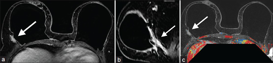 Case 2: 46-year-old female with bilateral prophylactic mastectomies and bilateral subpectoral implants. MRI: Contrast-enhanced (a) axial, (b) reformatted sagittal, and (c) postgadolinium with CAD overlay images demonstrate mildly increased prominence and enhancement (arrows) posterior and lateral to an intact right implant. This corresponded to the location and configuration of the AlloDerm® hammock/sling.