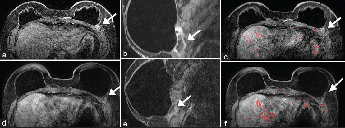 Case 3: 58-year-old female with bilateral mastectomies and implants. Prior MRI: Contrast-enhanced a) axial, b) reformatted sagittal of the left breast, and c) postgadolinium with CAD overlay MR images demonstrate an area of minimal non-mass enhancement in the location of the AlloDerm® (arrows) in the inframammary fold posterior and lateral to the implant. No worrisome enhancement kinetics is seen. Follow-up MRI 16 months later: There are intact implants and less conspicuity and prominence of the non-mass enhancement (d–f, arrows). This would be in keeping with interval incorporation of AlloDerm® into the host.