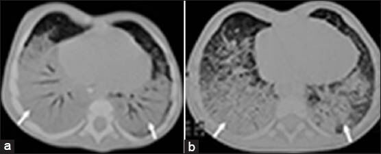 5-month-old male infant aspirated large amounts of paraffin oil causing respiratory distress diagnosed later as due to lipoid pneumonia (a) Chest computed tomography (CT) performed 1.5 month post-paraffin oil aspiration shows diffuse extensive airspace consolidations (arrows) in both lower lobes. (b) High-resolution chest CT taken 7 months after the incident shows persistent imaging findings (arrows) with minimal improvement.