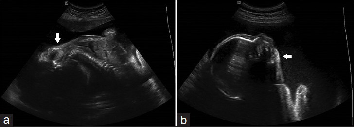 30-year-old nulliparous female in her second pregnancy at 28th week of pregnancy, fetus diagnosed with Pena-Shokeir syndrome. Two-dimensional ultrasound (a) longitudinal section through the fetus shows the persistent hyperextension of the spine (arrow). (b) Sagittal section shows the fetal head extension and micrognathia (arrow).