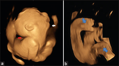 30-year-old nulliparous female in her second pregnancy at 28th week of pregnancy, fetus diagnosed with Pena-Shokeir syndrome. Three-dimensional ultrasound images in rendering mode (a) shows hyperextension of the head (white arrow) and micrognathia (red arrow), (b) shows twisting of the feet (blue arrows).