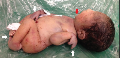 Baby born at 32nd week of gestation. Postnatal image after unsuccessful attempt to resuscitate the newborn with Pena-Shokeir syndrome. The photograph shows twisted appearance of the hands and feet (white arrows), as well as the micrognathia (red arrow).