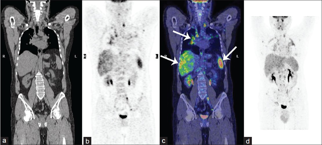 42-year-old male with fever, chest pain, and fatigue diagnosed with sarcoidosis. Pre-treatment 18F- FDG PET-CT total body scans of the patient from the base of the skull to the thighs: (a) CT scan, (b) PET scan, (c) Fusion coronal image, and (d) Maximum Intensity Projection (MIP) image show multiple abnormal uptakes of F18-FDG. In particular, some abnormal accumulations of radiotracer are present at the level of right pulmonary hilum, liver, and spleen (arrows in c).