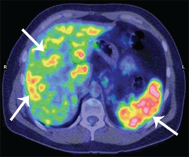 42-year-old male with fever, chest pain, and fatigue later diagnosed with sarcoidosis. Pre-treatment 18F-FDG PET- CT scan, transaxial fusion image at the level of the upper abdomen shows abnormal uptakes of radiotracer in the liver and spleen (arrows).