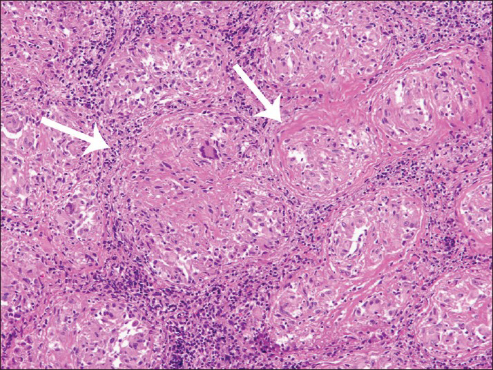 42-year-old male with fever, chest pain, and fatigue later diagnosed with sarcoidosis. Photomicrograph of the biopsy sample stained with hematoxylin and eosin shows confluent sarcoid granulomata pattern in thoracic lymph node (arrows). Tissue showed occasional multinuclear giant cells Langhans type, mononuclear phagocytes, and lymphocytes. No necrosis was present (×100).