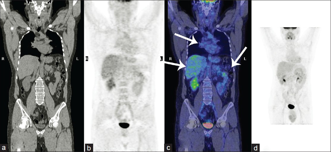 42-year-old male with fever, chest pain, and fatigue later diagnosed with sarcoidosis. Post treatment total body 18F-FDG PET/CT scan: (a) CT scan, (b) PET scan, (c) Fusion coronal image, and (d) MIP image show a physiological distribution of the radiotracer and the complete disappearance of abnormal uptakes at level of right pulmonary hilum, liver, and spleen (arrows in c).