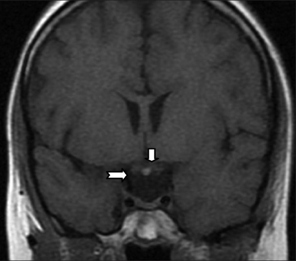 21-year-old female patient with complaints of forgetfulness, twitching of eyes, and short stature later diagnosed with coexistence of ectopic neurohypophysis, corpus callosum dysgenesis, and periventricular neuronal heterotopia. A coronal non-contrast T1-weighted MRI image reveals a hyperintense ectopic posterior pituitary adjacent to the optic chiasm, at the level of the median eminence of the hypothalamus (arrows). The bright dot in the ectopic site indicates neurohypophysis.