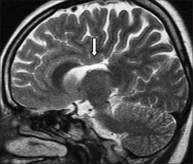 21-year-old female patient with complaints of forgetfulness, twitching of eyes, and short stature later diagnosed with coexistence of ectopic neurohypophysis, corpus callosum dysgenesis, and periventricular neuronal heterotopia. Sagıttal T2-weighted MRI image reveals partial dysgenetic view of the corpus callosum and protrusion of cingulated gyrus (arrow).