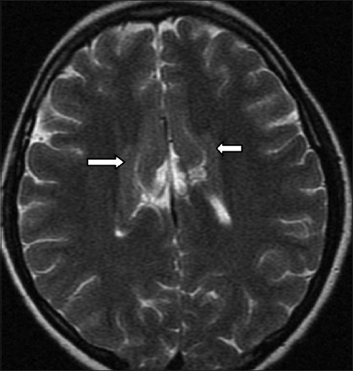 21-year-old female patient with complaints of forgetfulness, twitching of eyes, and short stature later diagnosed with coexistence of ectopic neurohypophysis, corpus callosum dysgenesis, and periventricular neuronal heterotopia. Axıal T2-weighted MRI image reveals an appearance that is compatible with periventricular-subependymal heterotopic neuronal tissue (arrows).