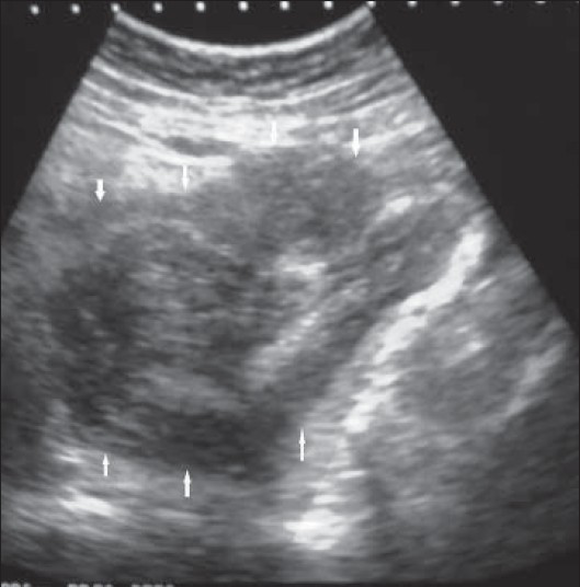 43-year-old female with protruding perineal mass diagnosed with angiomyxoma. Ultrasonography abdomen reveals a heterogeneous (predominantly hypoechoic mass involving abdomino-pelvic cavity (arrows).