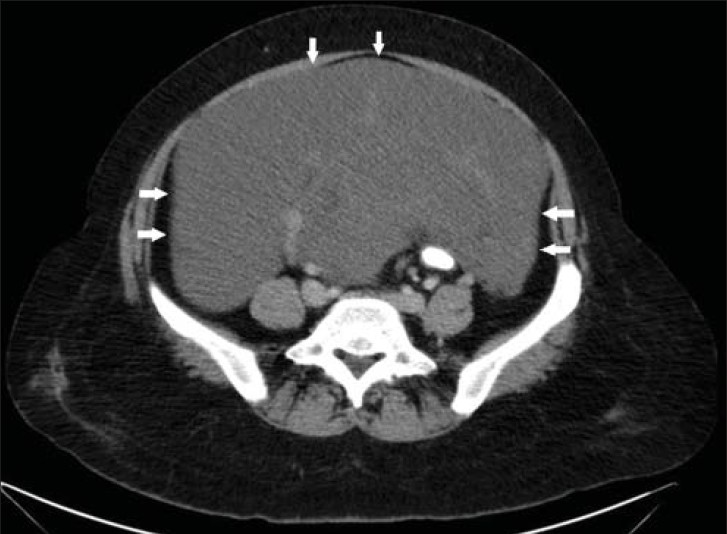 43-year-old female with protruding perineal mass diagnosed with angiomyxoma. Contrast-enhanced axial CT scan images of abdomen and pelvis shows a large hypodense mass lesion with well-defined margins (arrow).