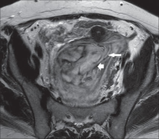 43-year-old female with protruding perineal mass diagnosed with angiomyxoma. T2W axial MRI image shows hyperintense mass with swirled appearance (long arrow) and hypointense linear foci (short arrow).