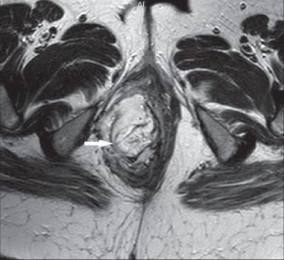 43-year-old female with protruding perineal mass diagnosed with angiomyxoma. T2W axial MRI image shows hyperintense mass involving right ischiorectal fossa with swirled appearance (arrow).