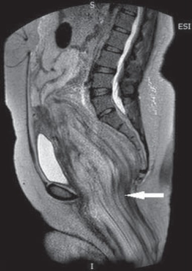 43-year-old female with protruding perineal mass diagnosed with angiomyxoma. T2W parasagittal MRI image shows hyperintense mass with swirled appearance herniating into ischiorectal fossa (arrow).