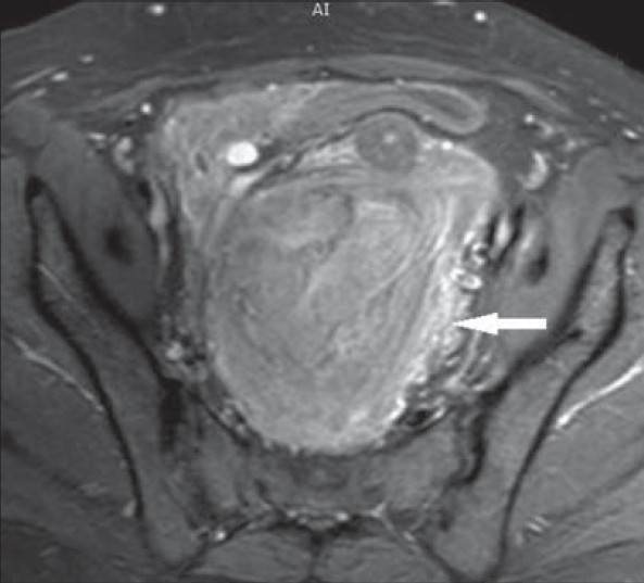 43-year-old female with protruding perineal mass diagnosed with angiomyxoma. Contrast enhanced T1W axial MRI image shows intense enhancement of the mass (arrow).