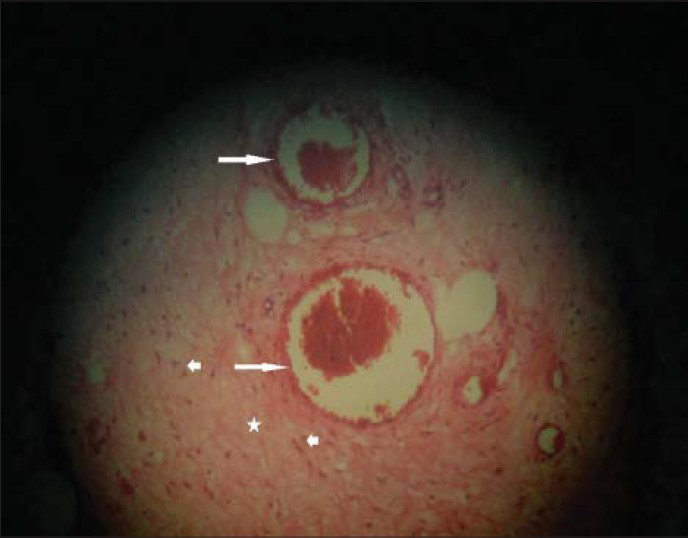 43-year-old female with protruding perineal mass diagnosed with angiomyxoma. Histopathological biopsy with hematoxylin and eosin stain (×100) shows medium sized vessels (long arrows) with scattered spindle cells (short arrows) within myxoid stroma (asterix) suggestive of angiomyxoma.