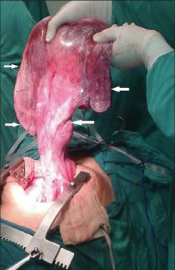 43-year-old female with protruding perineal mass diagnosed with angiomyxoma. Intraoperative photograph (mass lifted by the surgeon for demonstration purpose) shows highly vascular fleshy mass (arrows).