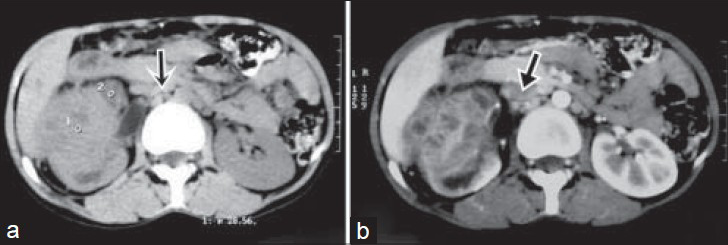 34-year-old woman with intermittent right flank pain diagnosed with genitourinary tuberculosis. (a) Computed tomography (CT) shows heterogeneous enhancing mass involving the upper and mid pole of the right kidney with aortocaval and paracaval lymphadenopathy(arrow) and (b) contrast enhanced CT scan of the abdomen show presence of rim enhancement with central necrosis in lymph nodes (arrow).
