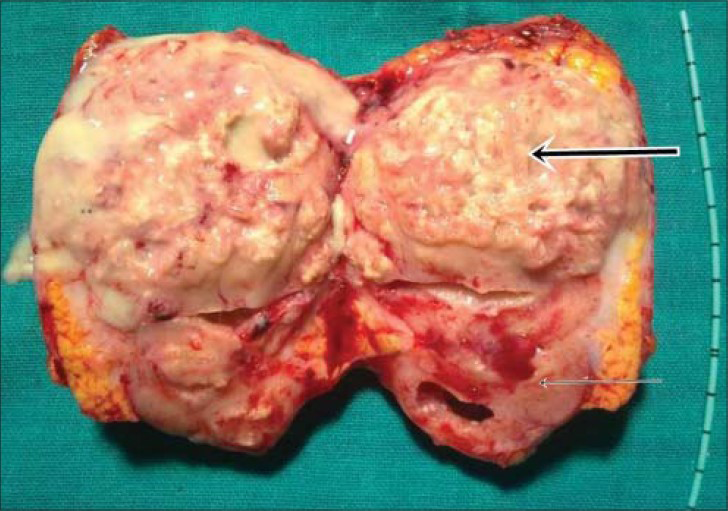 34-year-old woman with intermittent right flank pain diagnosed with genitourinary tuberculosis. Section removed during right side nephrectomy shows normal looking kidney (thin arrow and renal mass with pus around it (thick arrow).