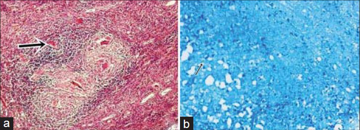 34-year-old woman with intermittent right flank pain diagnosed with genitourinary tuberculosis. Histopathology slides (a) stained with hematoxylin and eosin (×100) shows presence of multiple granulomas (thick arrow) and (b) stained with Ziehl-Neelsen stain (×100) shows presence of acid-fast bacilli (thin arrow).