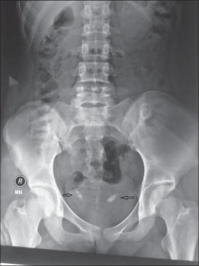 15-year-old female with bilateral flank pain, which was suspected to be due to stones in bilateral ureterovesical junction, later diagnosed as due to calcification of collagen used 12 years earlier to treat vesicoureteral reflux. Kidney ureter bladder graphy shows bilateral UVJ calcifications (arrow).