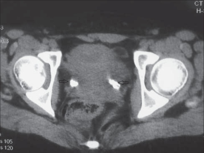 15-year-old female with bilateral flank pain, which was suspected to be due to stones in bilateral ureterovesical junction, later diagnosed as due to calcification of collagen used 12 years earlier to treat vesicoureteral reflux. Spiral CT scan of pelvis without intravenous and oral contrast shows bilateral UVJ calcifications (arrows).