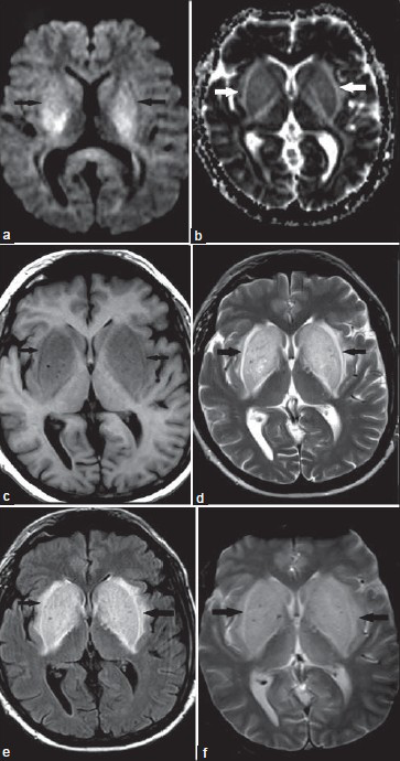 52-year-old man with sudden-onset chorea, altered mental status, behavioral alterations, and slurred speech for 2 days, diagnosed with reversible symmetrical basal ganglial lesions bilaterally, related to diabetic nephropathy and chronic renal failure. (a) Axial unenhanced diffusion-weighted image demonstrates symmetrical hyperintense/bright areas involving the basal ganglia bilaterally. (b) Axial unenhanced apparent diffusion coefficient (ADC) image demonstrates reduced ADC values in the central parts and elevated ADC values in the periphery. (c) Axial unenhanced T1-weighted image demonstrates symmetrical hypointense areas involving the basal ganglia bilaterally. No significant mass effect is noted. (d-f) Axial unenhanced T2-weighted, fluid attenuation inversion recovery (FLAIR), and T2*-weighted images show symmetrical hyperintense areas involving the basal ganglia bilaterally.