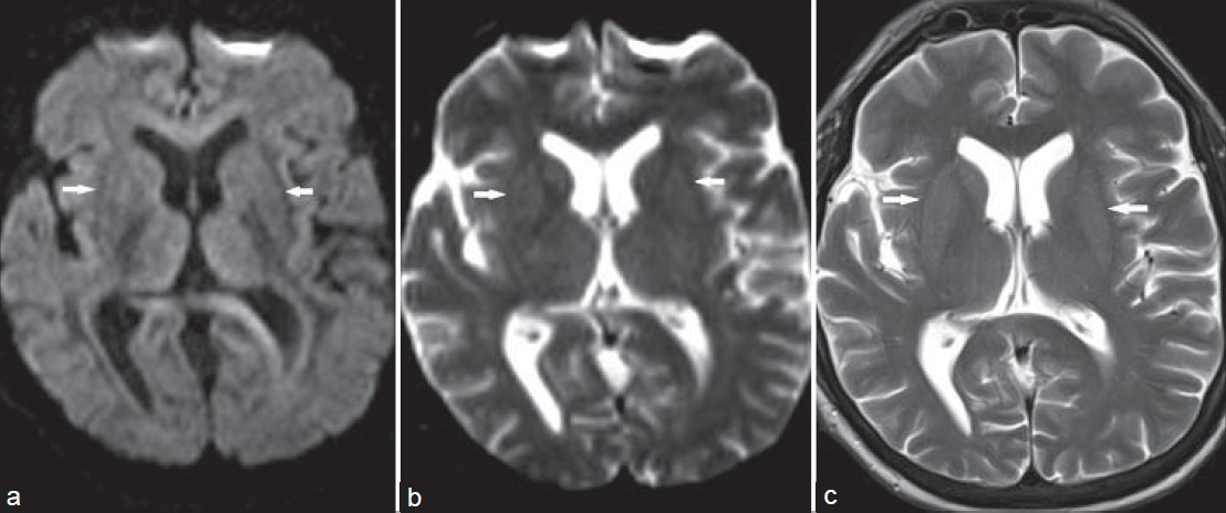 52-year-old man with sudden-onset chorea, altered mental status, behavioral alterations, and slurred speech since 2 days, diagnosed with reversible symmetrical basal ganglial lesions bilaterally, related to diabetic nephropathy and chronic renal failure. Follow-up (a) axial unenhanced diffusion-weighted images, (b) axial unenhanced apparent diffusion coefficient (ADC) images, and (c) axial unenhanced T2-weighted images demonstrate complete resolution of the altered signal intensities in the basal ganglia bilaterally, without any residual abnormalities.