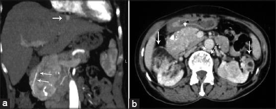 63-year-old woman with abdominal pain diagnosed with angiomyolipoma (AML) of the kidney and liver, and islet cell tumor of the pancreas. Contrast-enhanced computed tomography (a) Coronal reconstruction image obtained during the arterial phase of enhancement shows a large heterogeneously enhanced mass. Gastroduodenal artery is encased by the mass (arrows). Hyperenhancing lesion in the liver is also seen (arrow). (b) Axial image obtained in the venous phase of enhancement shows that the mass enhanced homogenously and had calcifications (arrow head). There are bilateral renal AMLs containing fat density (arrows). Note also discrete vertebral sclerotic lesions (dashed arrow).