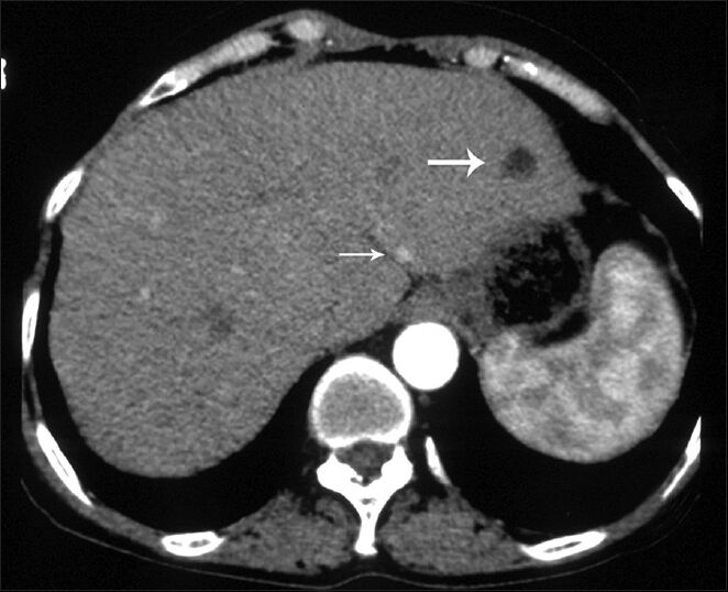 63-year-old woman with abdominal pain diagnosed with angiomyolipoma (AML) of the kidney and liver, and islet cell tumor of the pancreas. Axial image obtained in arterial phase shows an AML in segment 2 of the liver containing homogenous fat density without enhancement (large arrow) and hyperenhancing small lesion (small arrow).