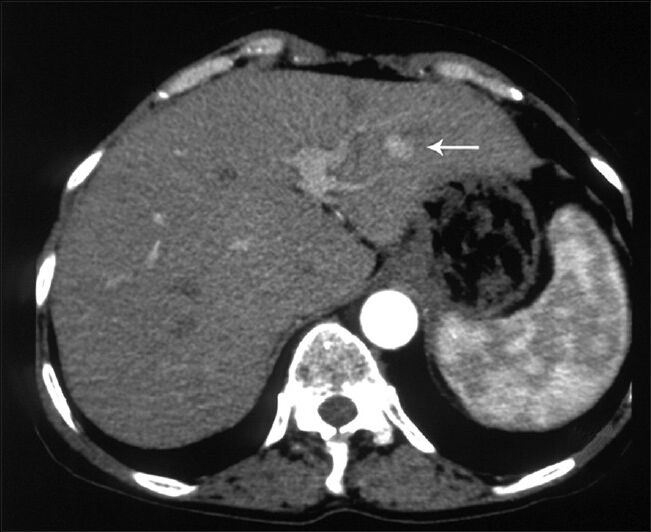 63-year-old woman with abdominal pain diagnosed with angiomyolipoma of the kidney and liver, and islet cell tumor of the pancreas. Axial image obtained in the arterial phase shows a hyperenhancing lesion in segment 3 of the liver (arrow).