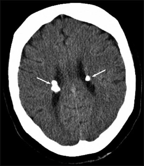 63-year-old woman with abdominal pain diagnosed with angiomyolipoma of the kidney and liver, and islet cell tumor of the pancreas. Axial computed tomography image of the brain shows calcified subependymal nodules (arrows).