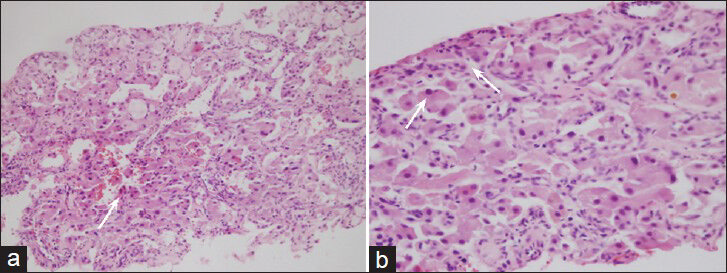 63-year-old woman with abdominal pain diagnosed with angiomyolipoma of the kidney and liver, and islet cell tumor of the pancreas. H and E, stained specimen (a) ×200 and (b) ×400 show neoplastic cells forming solid sheets and also have large eosinophilic cytoplasm with moderate nuclear pleomorphism (arrows). Some neoplastic cells show binucleation.