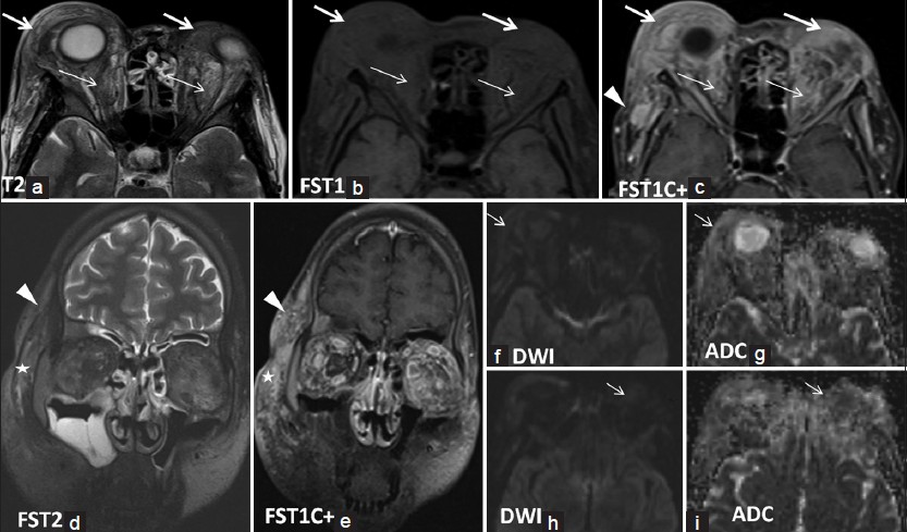 25-year-old woman with a long history of progressive bilateral protrusion of eyes, periorbital swelling without vision changes presented with intermittent attacks of retrobulbar pain and headache later diagnosed with idiopathic orbital pseudotumor. (a) Axial T2, (b) axial fat-saturated T1, (c) axial post-contrast fat-saturated T1, (d) coronal fat-saturated T2, and (e) coronal fat-saturated T1-weighted images with (f and g) diffusion-weighted images with corresponding (h and i) apparent diffusion coefficient (ADC) maps demonstrate multispatial massive infiltrative changes including pre-septal (long thick arrows) and post-septal orbital structures (thin arrows) and soft tissue of buccal (asterisks on d and e) and zygomatic regions (arrowheads on c-e). Infiltrated areas are enhancing, T2 hypointense in appearance with restricted diffusion (arrows on f and i), suggestive of either lymphoproliferative diseases or sarcoidosis.