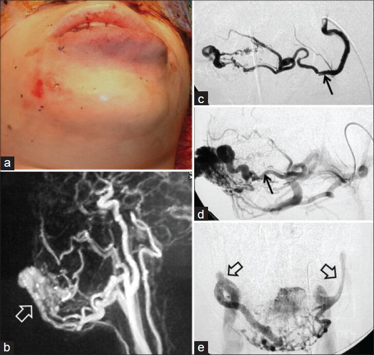 13-year-old female with hemangioma of the lower lip. a) Clinical photograph demonstrates diffuse swelling of the lower lip. b) Contrast-enhanced MR angiography demonstrates vascular supply to the lesion as well as lesion matrix (open white arrow). c and d) Serial images of angiographic study following selective lingual artery injection demonstrate early (arrow) and late arterial phases (arrow) of an arteriovenous malformation. e) Frontal images in venous phase show the draining veins bilaterally (open arrows). MR angiogram, although useful, lacks specific details.