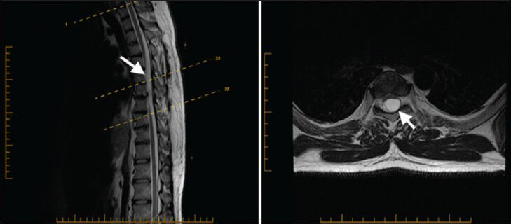 27-year-old male presented with chronic low back pain for a year and half after he sustained minor back trauma at work. Pain was radiating to both lower extremities, but more to the right side. It was later diagnosed as a form of spinal cord malformation. a) Sagittal T2W and b) axial T2W MRI of the thoracic spine show arachnoid cyst posterior to T5 and T6 segments of the spinal cord causing anterior displacement of the cord and posterior cord flattening (arrowhead). Epidural arachnoid cyst herniation through the posterior dura is a possible differential diagnosis.